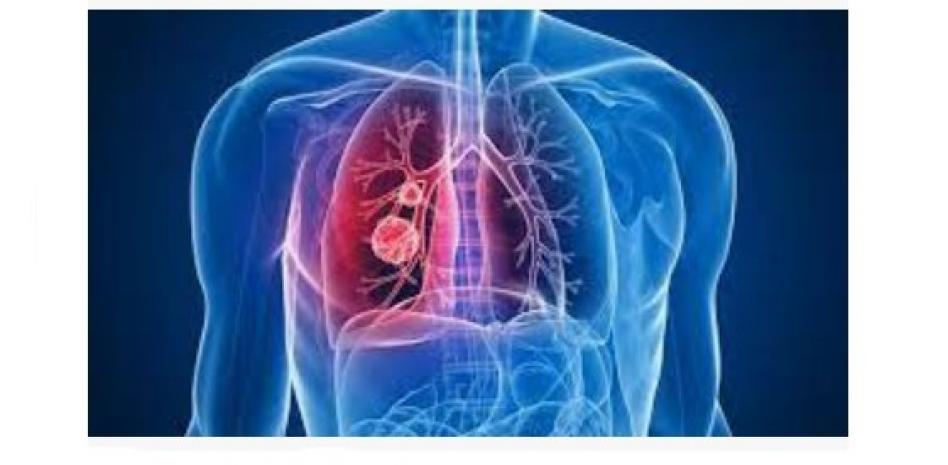 Redefine la medicina personalizada el tratamiento del cáncer de pulmón
